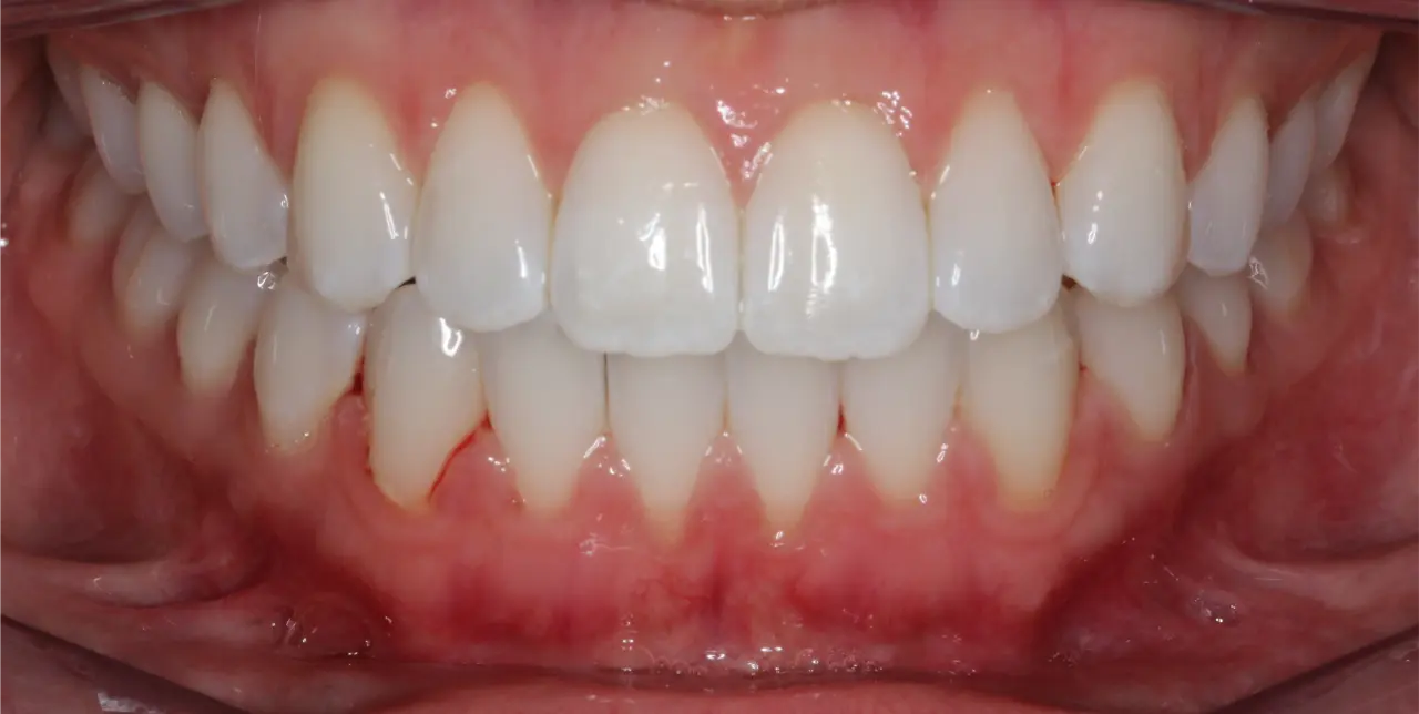 DC-orthodontist-parramatta-teeth-image-after 1 (1)