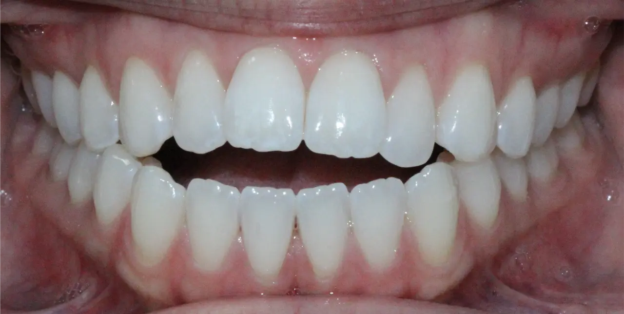 DC-orthodontist-parramatta-teeth-image-before 1