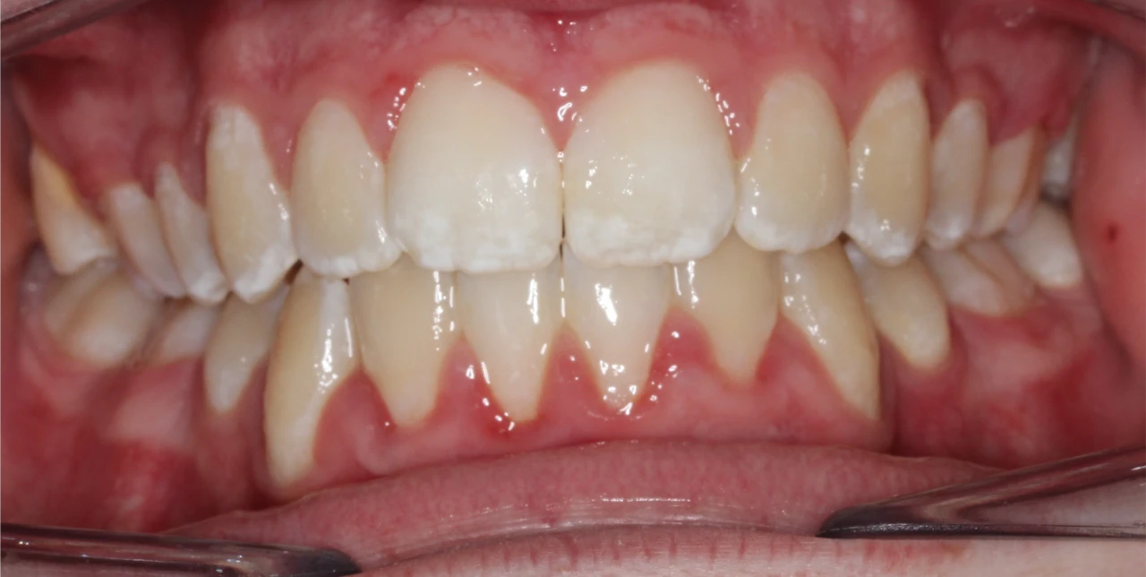 orthodontist-patient-epping-after-photo-teeth