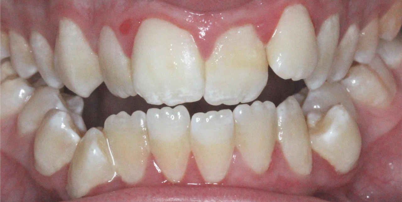 orthodontist-patient-epping-before-photo-teeth