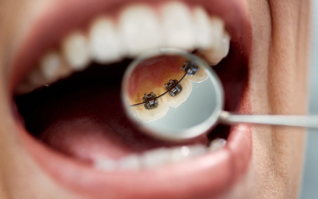 What Are Lingual Braces? A Complete Guide